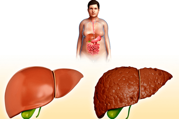 razlika zdrave i nezdrave jetre