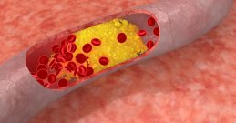 Kako smanjiti kolesterol u nekoliko tjedana - prirodno, sigurno i lako